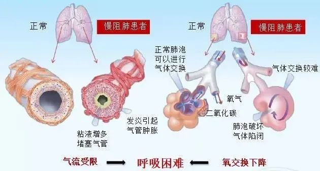 逆转慢阻肺最新技术，重塑呼吸健康新希望